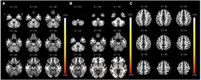 Decreased resting-state functional connectivity of the habenula-cerebellar in a major depressive disorder